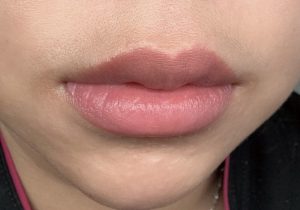 The 2026 Medical-Aesthetic Guide to Dark Lip Correction
