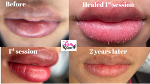 The 2026 Medical-Aesthetic Guide to Dark Lip Correction
