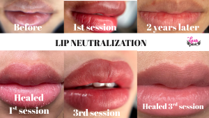 The 2026 Medical-Aesthetic Guide to Dark Lip Correction
