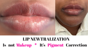 The 2026 Medical-Aesthetic Guide to Dark Lip Correction
