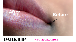 The 2026 Medical-Aesthetic Guide To Dark Lip Correction