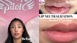 The 2026 Medical-Aesthetic Guide to Dark Lip Correction
