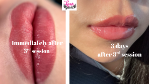 The 2026 Medical-Aesthetic Guide to Dark Lip Correction
